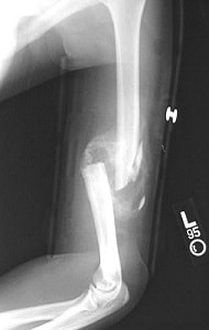 An x-ray of a humerus that broke during an arm-wrestling match.